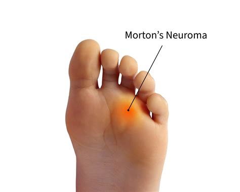 morton's neuroma surgery success rate